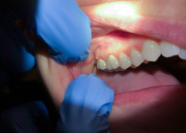 Best Chipped Tooth Repair Near Me  in Woodinville, WA